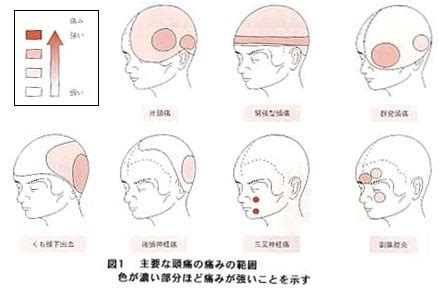 頭頂頭痛 原因|頭痛の場所別に原因を解説！ 〜 前頭部・こめかみ・。